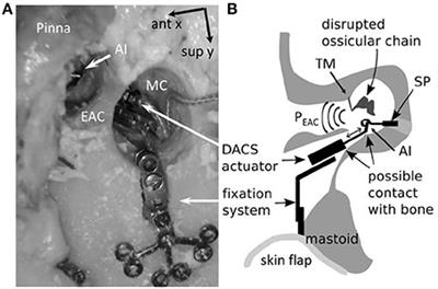 In situ Probe <mark class="highlighted">Microphone</mark> Measurement for Testing the Direct Acoustical Cochlear Stimulator